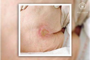Read more about the article INSTRUMEN LUKA TEKAN (PRESSURE ULCER)