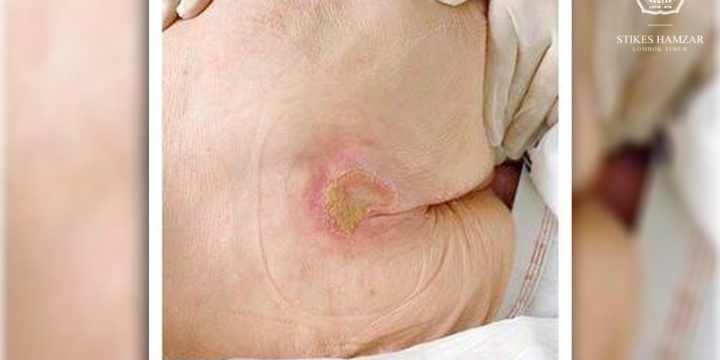 INSTRUMEN LUKA TEKAN (PRESSURE ULCER)